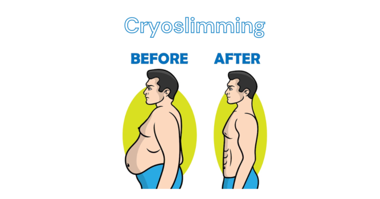 Cryoslimming